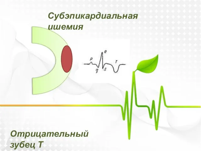 Субэпикардиальная ишемия Отрицательный зубец Т