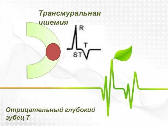 Трансмуральная ишемия Отрицательный глубокий зубец Т