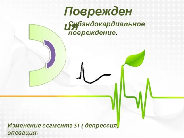 Повреждения Субэндокардиальное повреждение. Изменение сегмента ST ( депрессия, элевация)