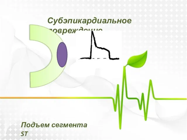 Субэпикардиальное повреждение Подъем сегмента ST