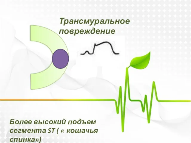 Трансмуральное повреждение Более высокий подъем сегмента ST ( « кошачья спинка»)