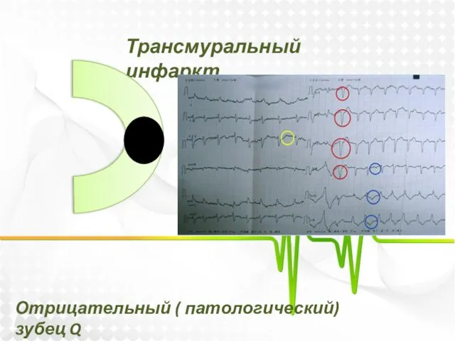 Трансмуральный инфаркт Отрицательный ( патологический) зубец Q