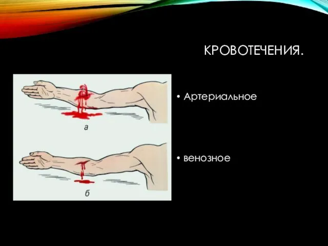 КРОВОТЕЧЕНИЯ. Артериальное венозное