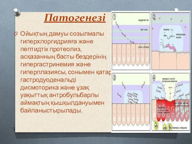 Патогенезі Ойықтың дамуы созылмалы гиперхлоргидрияға және пептидтік протеолиз, асқазанның басты бездерінің