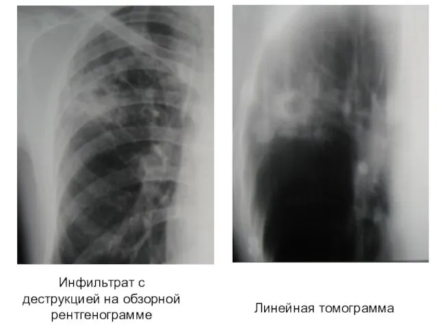 Инфильтрат с деструкцией на обзорной рентгенограмме Линейная томограмма