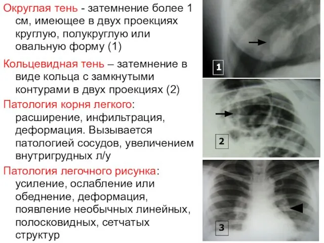 Округлая тень - затемнение более 1 см, имеющее в двух проекциях