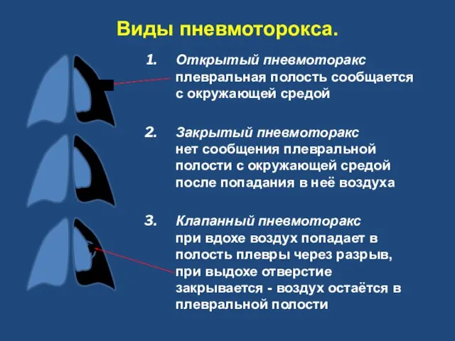 Виды пневмоторокса. Открытый пневмоторакс плевральная полость сообщается с окружающей средой Закрытый