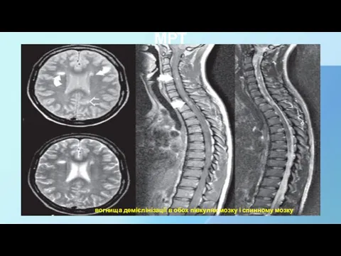 МРТ вогнища демієлінізації в обох півкулях мозку і спинному мозку