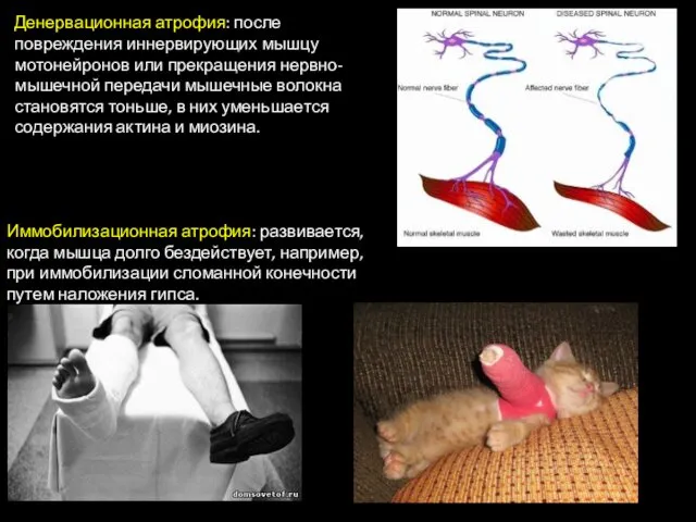 Денервационная атрофия: после повреждения иннервирующих мышцу мотонейронов или прекращения нервно-мышечной передачи