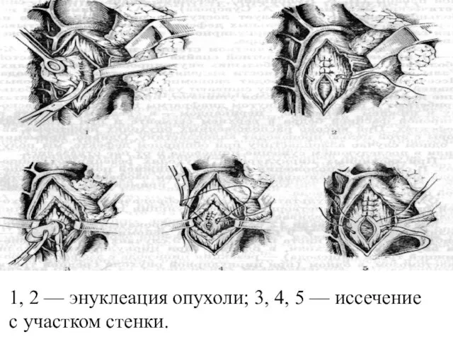 1, 2 — энуклеация опухоли; 3, 4, 5 — иссечение с участком стенки.