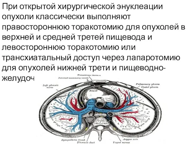 При открытой хирургической энуклеации опухоли классически выполняют правостороннюю торакотомию для опухолей