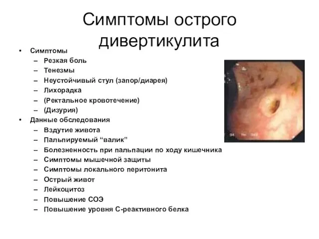 Симптомы острого дивертикулита Симптомы Резкая боль Тенезмы Неустойчивый стул (запор/диарея) Лихорадка