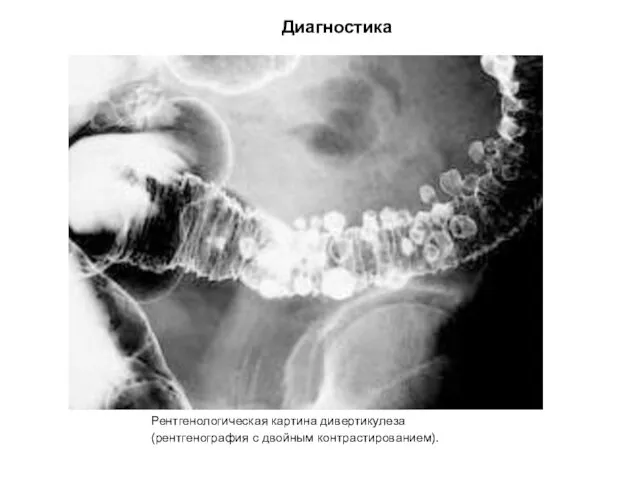 Диагностика Рентгенологическая картина дивертикулеза (рентгенография с двойным контрастированием).