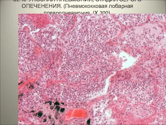 81. КРУПОЗНАЯ ПНЕВМОНИЯ, СТАДИЯ СЕРОГО ОПЕЧЕНЕНИЯ. (Пневмококковая лобарная плевропневмония, (Х 200). . .