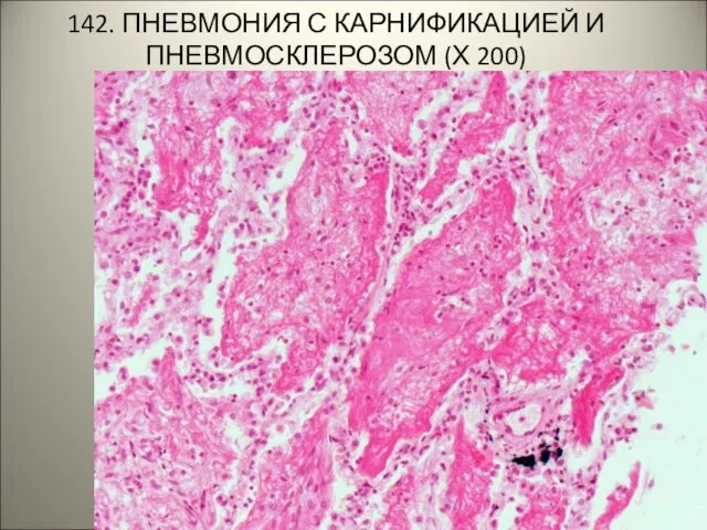 142. ПНЕВМОНИЯ С КАРНИФИКАЦИЕЙ И ПНЕВМОСКЛЕРОЗОМ (Х 200)