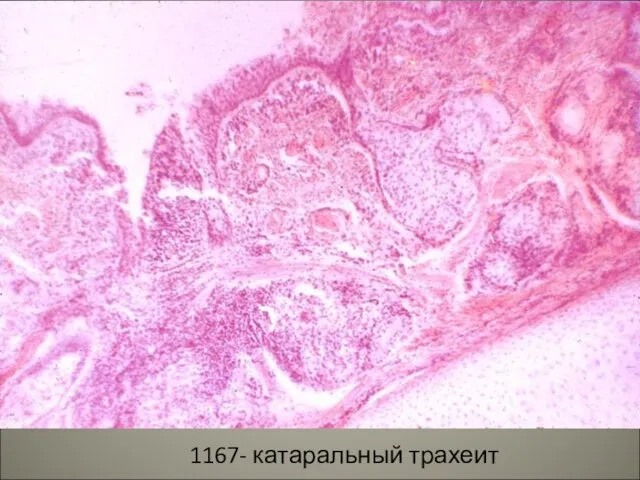 1167- катаральный трахеит