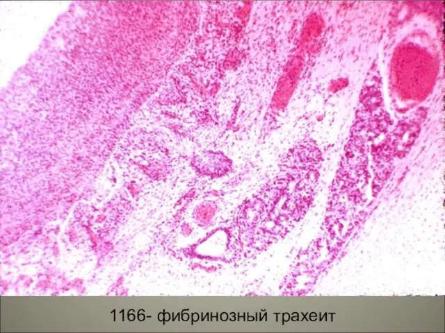 1166- фибринозный трахеит