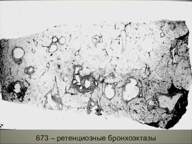 673 – ретенциозные бронхоэктазы