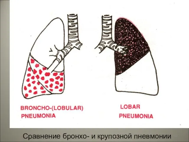 Сравнение бронхо- и крупозной пневмонии