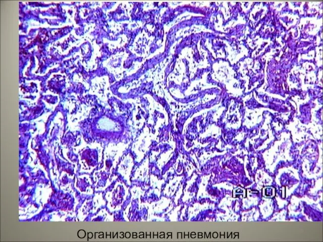 Организованная пневмония