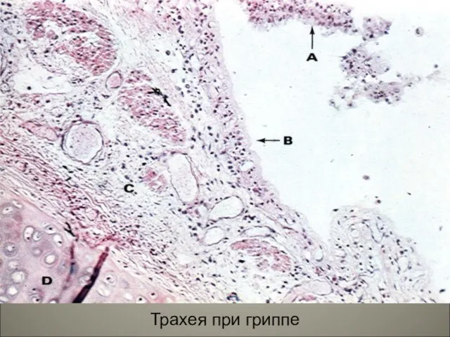 Трахея при гриппе