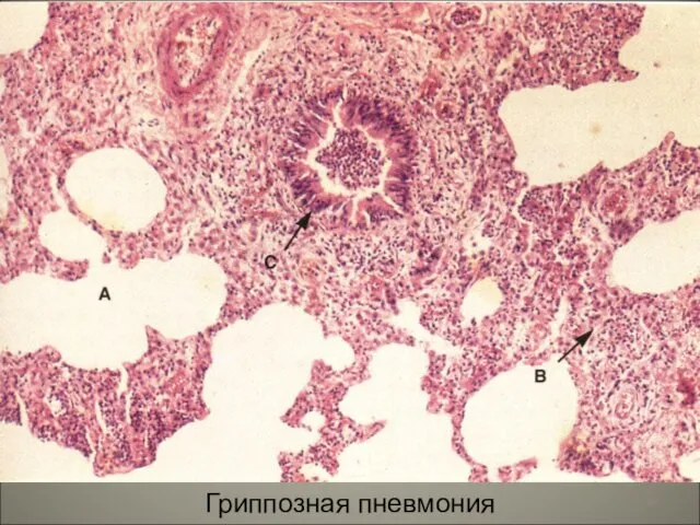 Гриппозная пневмония