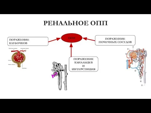 ОПП ПОРАЖЕНИЕ КЛУБОЧКОВ РЕНАЛЬНОЕ ОПП ПОРАЖЕНИЕ КАНАЛЬЦЕВ И ИНТЕРСТИЦИЯ ПОРАЖЕНИЕ ПОЧЕЧНЫХ СОСУДОВ