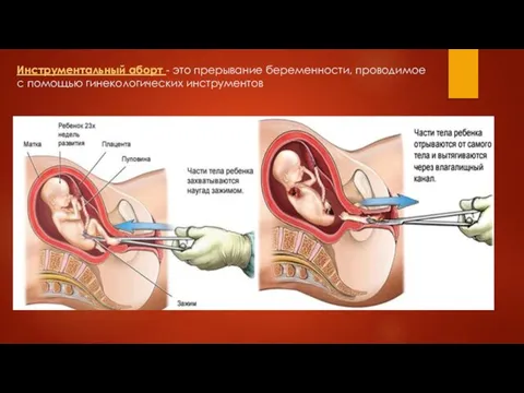 Инструментальный аборт - это прерывание беременности, проводимое с помощью гинекологических инструментов