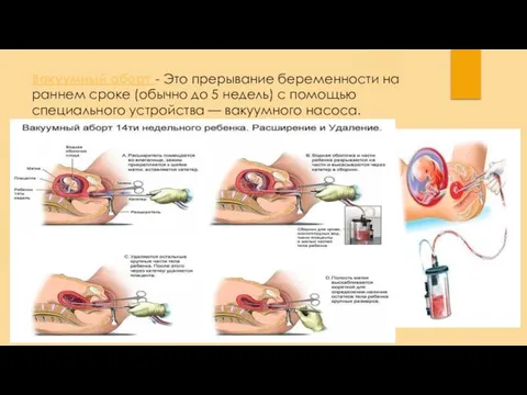 Вакуумный аборт - Это прерывание беременности на раннем сроке (обычно до