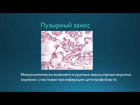 Пузырный занос Микроскопически выявляется крупные аваскулярные ворсины хориона с участками пролиферации цитотрофобласта