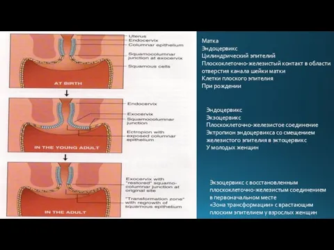 Матка Эндоцервикс Цилиндрический эпителий Плоскоклеточно-железистый контакт в области отверстия канала шейки