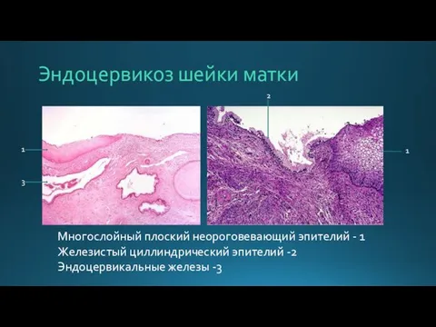 Эндоцервикоз шейки матки Многослойный плоский неороговевающий эпителий - 1 Железистый циллиндрический