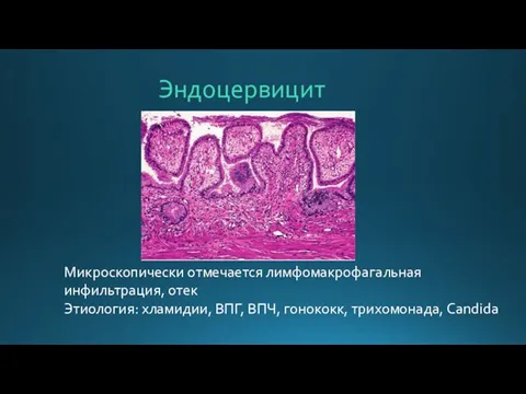 Эндоцервицит Микроскопически отмечается лимфомакрофагальная инфильтрация, отек Этиология: хламидии, ВПГ, ВПЧ, гонококк, трихомонада, Candida