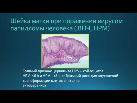 Шейка матки при поражении вирусом папилломы человека ( ВПЧ, НРМ) Главный
