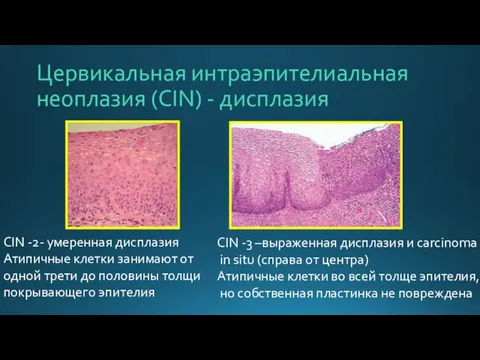 Цервикальная интраэпителиальная неоплазия (CIN) - дисплазия CIN -2- умеренная дисплазия Атипичные