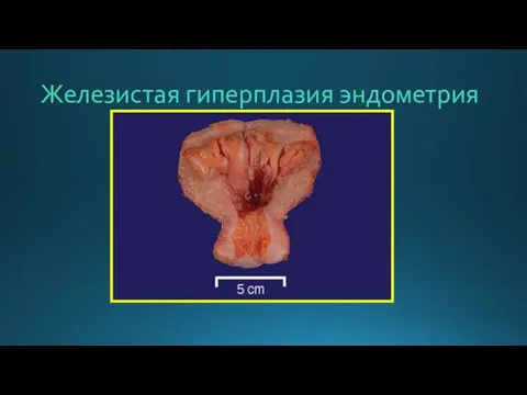 Железистая гиперплазия эндометрия