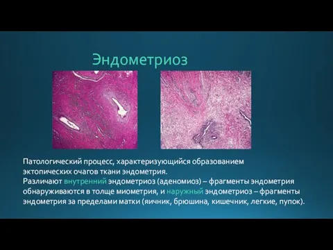 Эндометриоз Патологический процесс, характеризующийся образованием эктопических очагов ткани эндометрия. Различают внутренний