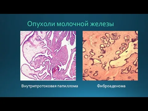 Опухоли молочной железы Внутрипротоковая папиллома Фиброаденома