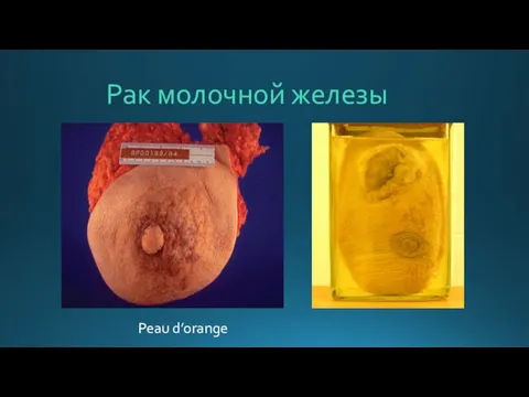 Рак молочной железы Peau d’orange