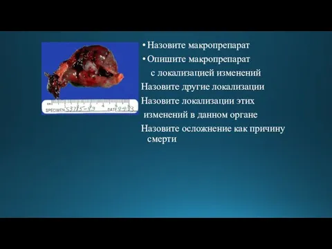 Назовите макропрепарат Опишите макропрепарат с локализацией изменений Назовите другие локализации Назовите