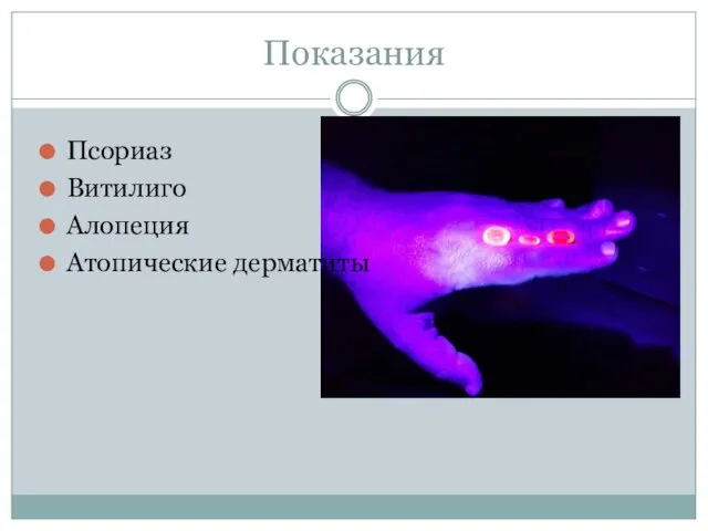 Показания Псориаз Витилиго Алопеция Атопические дерматиты