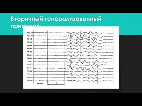 Вторичный генерализованный припадок