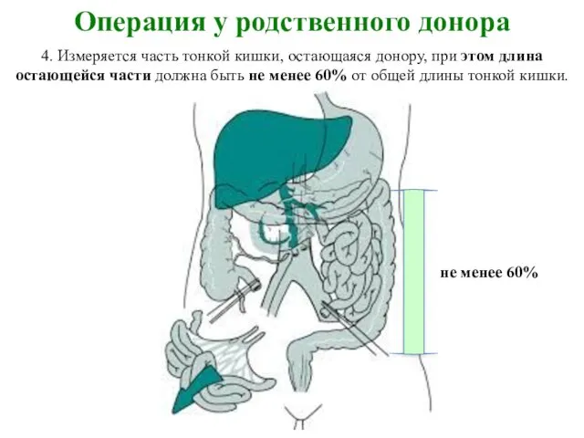 Операция у родственного донора 4. Измеряется часть тонкой кишки, остающаяся донору,