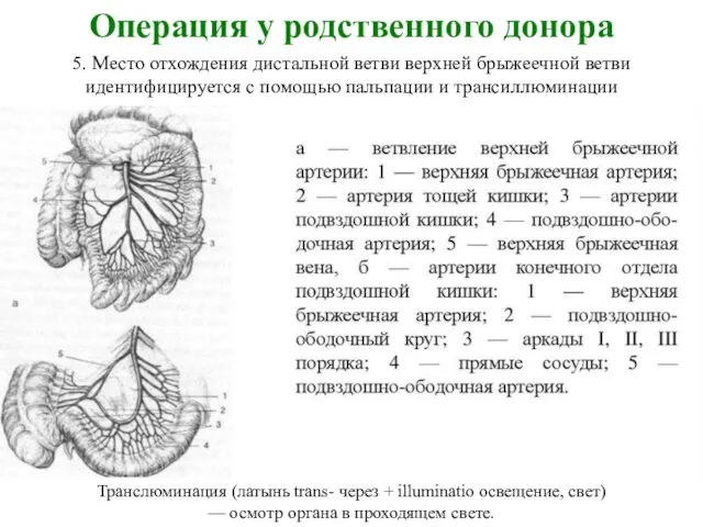 Операция у родственного донора 5. Место отхождения дистальной ветви верхней брыжеечной