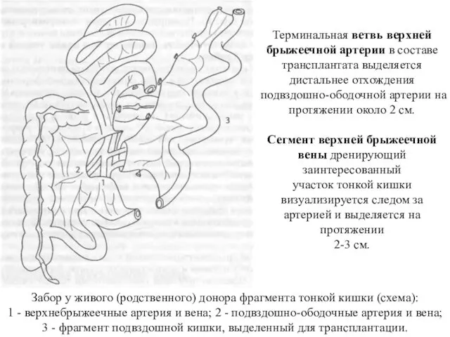 Терминальная ветвь верхней брыжеечной артерии в составе трансплантата выделяется дистальнее отхождения