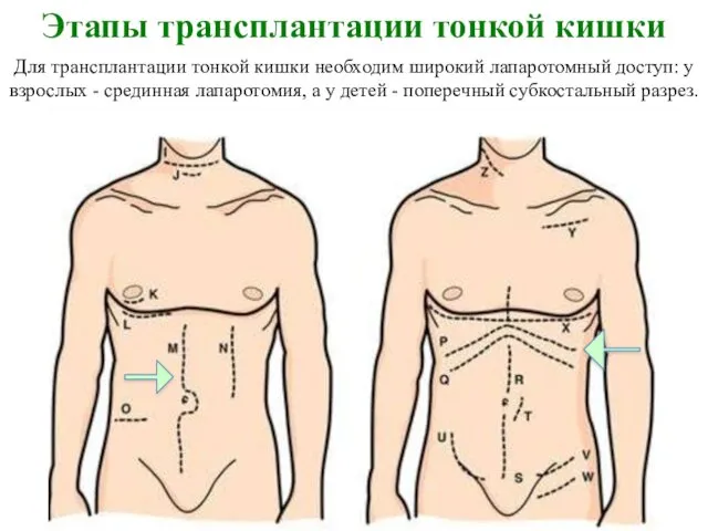 Этапы трансплантации тонкой кишки Для трансплантации тонкой кишки необходим широкий лапаротомный