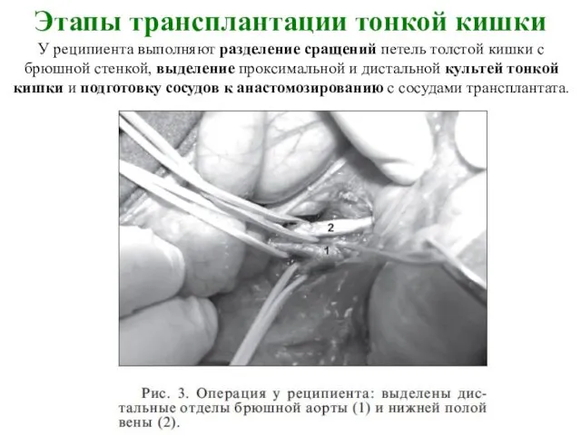 Этапы трансплантации тонкой кишки У реципиента выполняют разделение сращений петель толстой