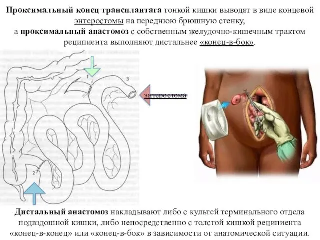 Проксимальный конец трансплантата тонкой кишки выводят в виде концевой энтеростомы на