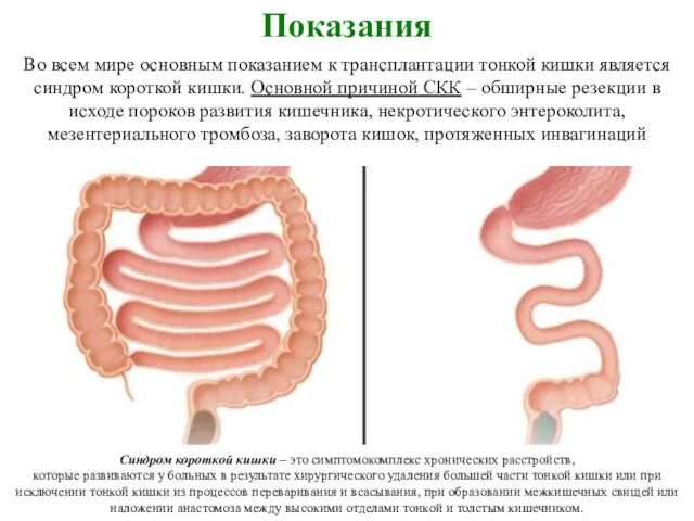 Показания Во всем мире основным показанием к трансплантации тонкой кишки является