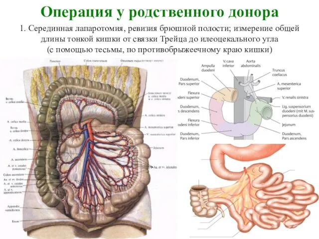 Операция у родственного донора 1. Серединная лапаротомия, ревизия брюшной полости; измерение